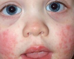 Ailedeki alerjik reaksiyonlar çocuklara miras olabilir