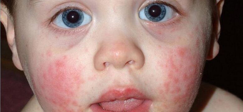 Ailedeki alerjik reaksiyonlar çocuklara miras olabilir